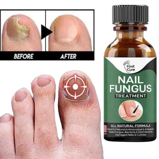 Nail Fungal Repair Serum | Nail Fungus Removal Gel